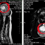 Butch MRI from OSU